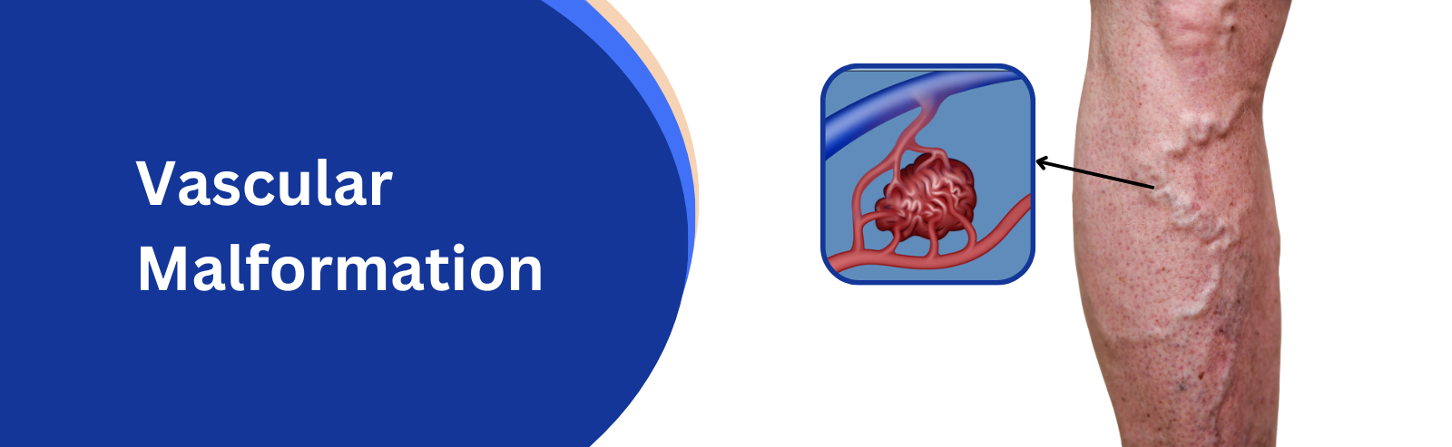 vascular_malformation_title_image_one_stop_vascular_solutions